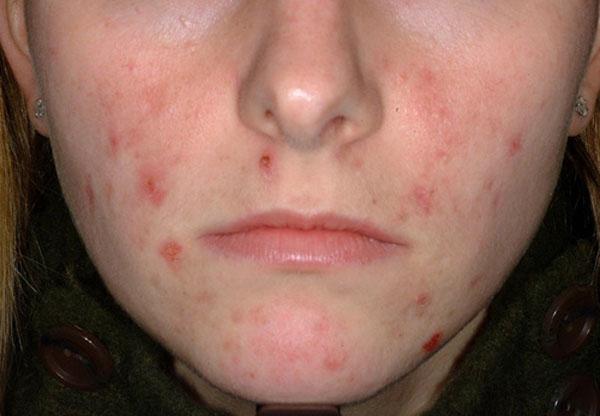 Aprenda a limpar a acne