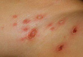 Streptodermia: esta doença é contagiosa ou não?