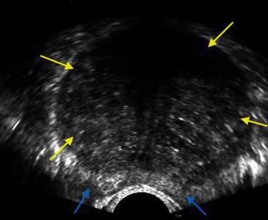 Ultra-sonografia transretal da próstata: descrição, preparação e recomendações
