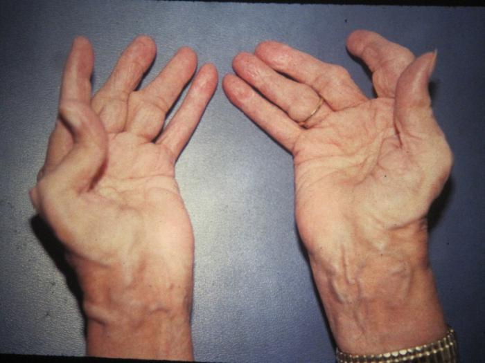 Qual é a diferença: artrite e artrose? As principais características de distinção